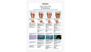 AROSHA Body Poster Cellulite-Stadien